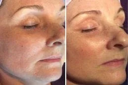 Before-and-After-Plasma-Pen-Treatment-in-Dubai