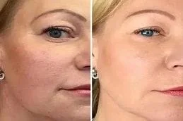 Before-and-After-Plasma-Pen
