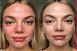 Before and After Rosacea Treatment