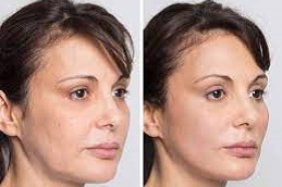 Before and After Silhouette Facelift