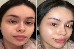 Before and After Skin Rejuvenation
