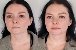 Before and After Volift Fillers