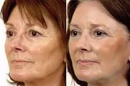 Before and after Laser Skin Tightening