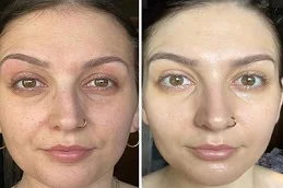 Birthmark Removal Treatment Before And After