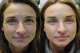 Birthmarks Removal Treatment After And Before