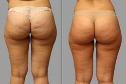 Cellfina-Treatment-Before-After