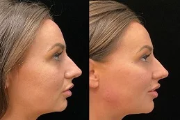 Cheek Augmentation after and before