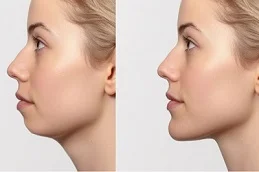 Cheek Augmentation before and after