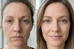 Cheek Fillers Injections After and Before