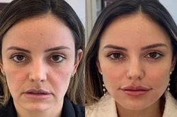 Cheek Fillers Injections Before and After
