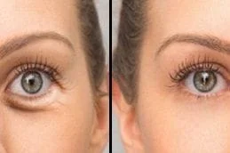 Dark-Circles-Treatment-Before-After