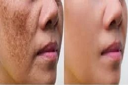 Dermal Pigmentation Treatment After and Before