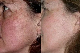 Dermal Pimentation Treatment Before and After