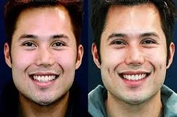 Dimple Creation After and Before