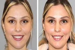 Dimple Creation Before and After