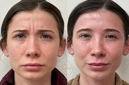 Fine Lines and Wrinkles After and Before
