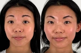 Fine Lines and Wrinkles Before and After