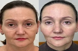 Fractional CO2 Laser Treatment After and Before