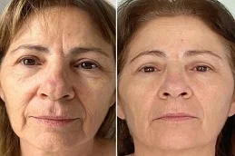 Fractional CO2 Laser Treatment Before and After