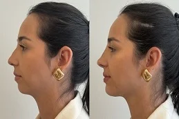 Halo Treatment After And Before