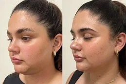 Halo Treatment Before And After