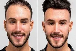 Hybrid Hair Transplant after and before