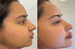 Jawline Contouring after and before