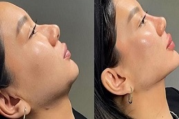 Jawline Contouring before and after
