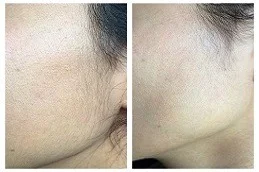 Laser Hair Bleaching After and Before