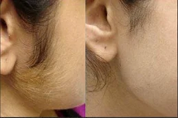 Laser Hair Bleaching Before And After