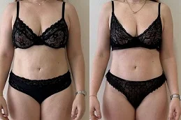 Laser Liposuction after and before
