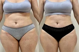 Laser Liposuction before and after