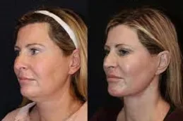 Laser Skin Tightening After and Before