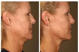 Laser Skin Tightening Befor and after