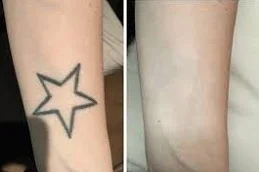 Laser Tattoo Removal after and before