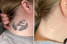 Laser Tattoo Removal before and after