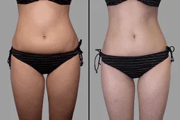 Lipolysis-Treatment-Before-and-After
