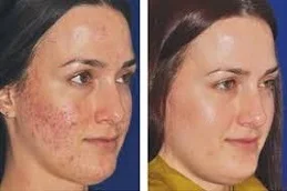 Microneedling after and before