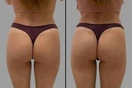 Non-Surgical-Bum-Lift-Before-After