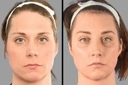Oxygen-Facial-Before-After