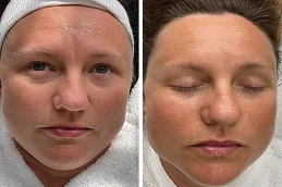 Oxygen Facial after and before