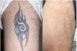 Picosure Tattoo Removal before and after