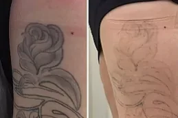 Picosure Tattoo removal after before and