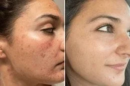 Plasma-Pen-Treatment-Before-and-After