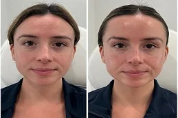 Radio Frequency Treatment After and Before
