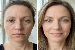 Radio Frequency Treatment Before and After