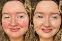 Rosacea Treatment Before and After