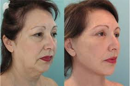 Silhouette Facelift Before and After