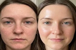 Skin Rejuvenation After & Before