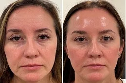 Skin Rejuvenation Before and After